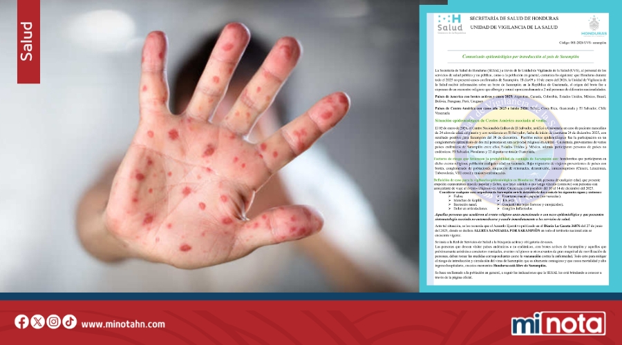 HONDURAS SE MANTIENE LIBRE DE SARAMPIÓN